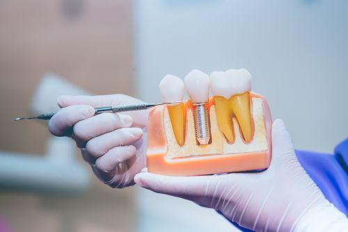 A dentist holding dental implant mould for illustration in Columbia, Md