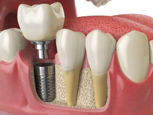 An illustration of dental implant in Columbia, Md